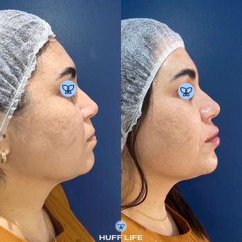 Preenchimento labial mento