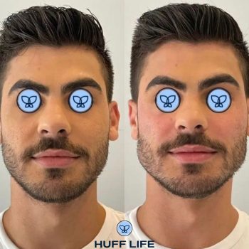 Preenchimento mandíbula masculina porto alegre