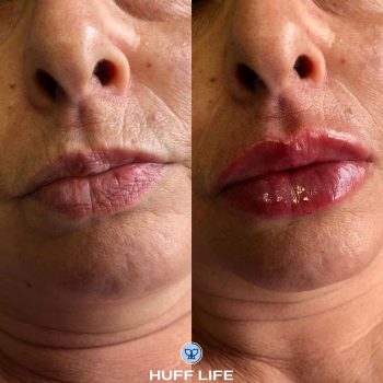 São Leopoldo: Preenchimento Labial 1ml para uma beleza única.