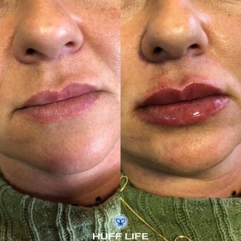 São Leopoldo: Preenchimento Labial 1ml para uma beleza única.