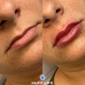 São Leopoldo: Preenchimento Labial 1ml para uma beleza única.