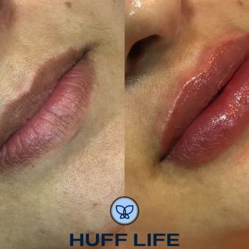 Preenchimento Labial 1ml em Porto Alegre: Beleza natural ao seu alcance."