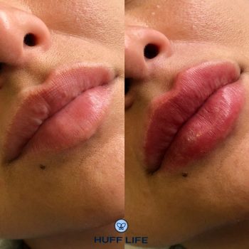 Preenchimento Labial 1ml em Porto Alegre: Beleza natural ao seu alcance."