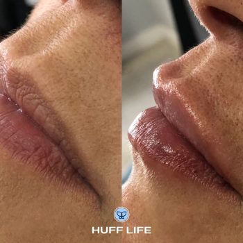 Preenchimento Labial 1ml em Porto Alegre: Beleza natural ao seu alcance."