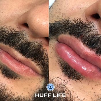 Preenchimento Labial 1ml em Canoas: Realce seus lábios com naturalidade.